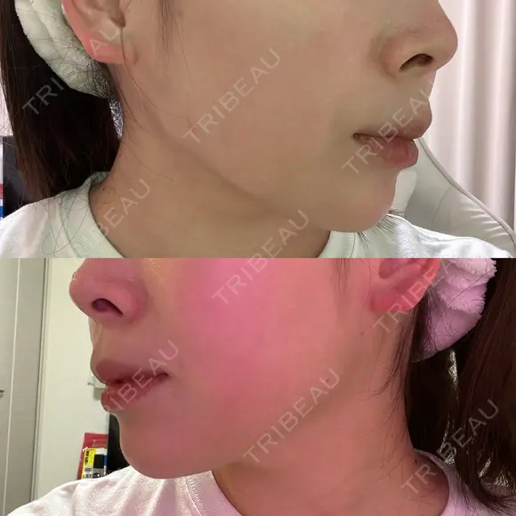 ボトックス（エラ・小顔） LE CLINIC AFTER メイン用