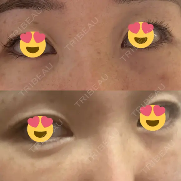 クマ治療 / 下まぶたの脂肪取り / ヒアルロン酸注入（目の下） / ボトックス（眉間） / ボトックス（目尻） / その他（鼻） YBC横浜美容外科 大宮院 DAY 2 メイン用