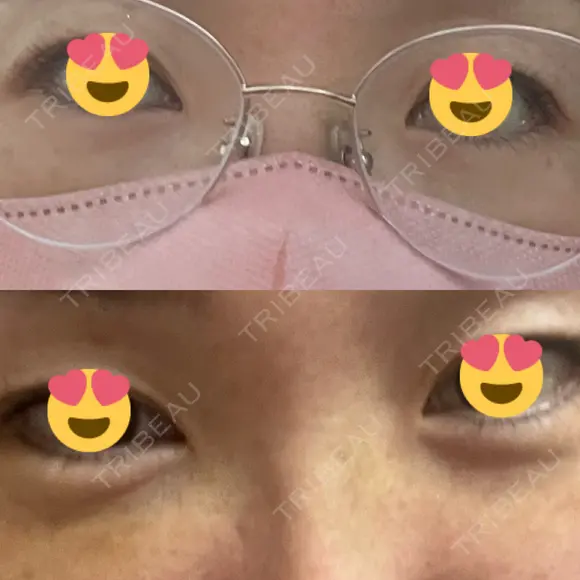 クマ治療 / 下まぶたの脂肪取り / ヒアルロン酸注入（目の下） / ボトックス（眉間） / ボトックス（目尻） / その他（鼻） YBC横浜美容外科 大宮院 DAY 3 メイン用