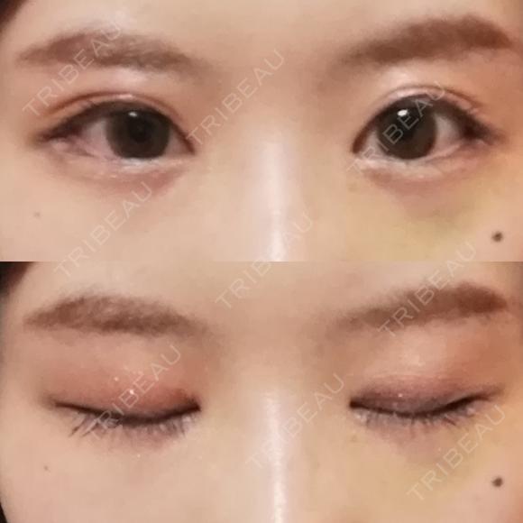 目頭切開 / 目尻切開 / 水光注射（ハリ・美肌） エートップ美容整形外科 DAY 10 メイン用