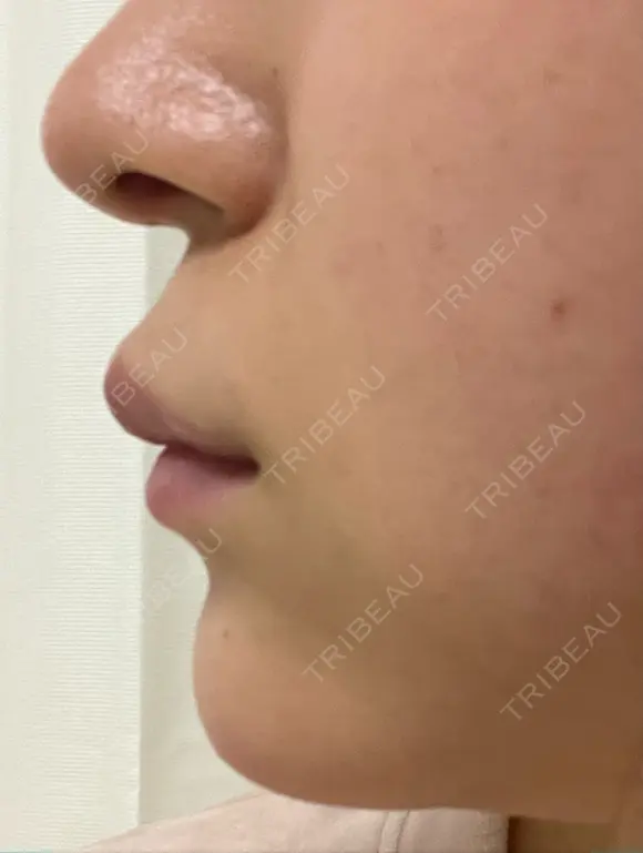 ヒアルロン酸注入（あご） 東京エビスクリニック AFTER メイン用