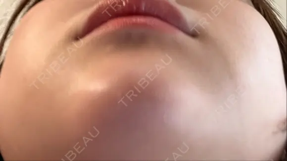 ヒアルロン酸注入（あご） 東京エビスクリニック DAY 6 メイン用