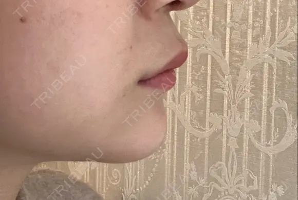 ヒアルロン酸注入（あご） 東京エビスクリニック DAY 6 メイン用