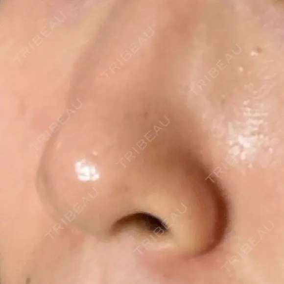 毛穴洗浄（ハイドラフェイシャルなど） / ニードルRF（ポテンツァなど） Zetith Beauty Clinic 銀座院 DAY 28 メイン用