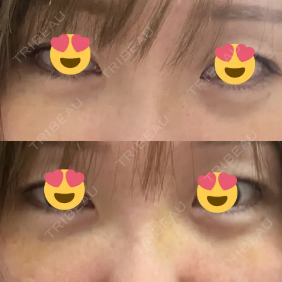 クマ治療 / 下まぶたの脂肪取り / ヒアルロン酸注入（目の下） / ボトックス（眉間） / ボトックス（目尻） / その他（鼻） YBC横浜美容外科 大宮院 DAY 5 メイン用