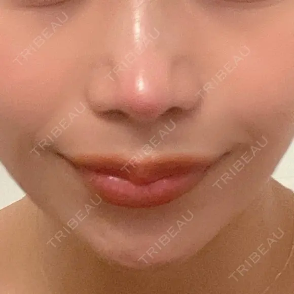 鼻尖形成（切開） / 鼻中隔延長（切開） / 軟骨移植 / 鼻翼基部形成（貴族手術） / 鼻柱下降・鼻唇角形成（猫手術） MAe Clinic 東京院 DAY 94 メイン用