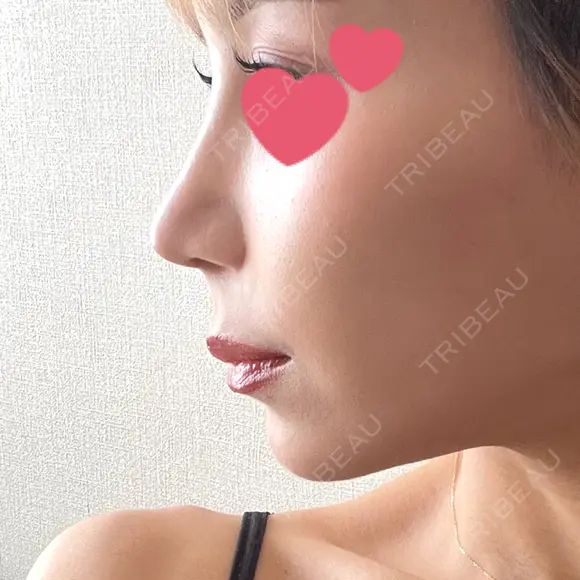 鼻尖形成（切開） / 鼻中隔延長（切開） / 軟骨移植 / 鼻翼基部形成（貴族手術） / 鼻柱下降・鼻唇角形成（猫手術） MAe Clinic 東京院 DAY 94 メイン用