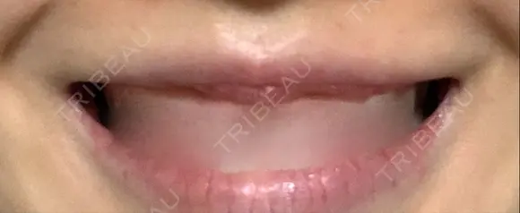 口唇縮小術 B-LINE CLINIC 池袋院 DAY 94 メイン用