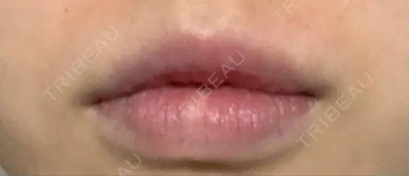 口唇縮小術 B-LINE CLINIC 池袋院 AFTER メイン用