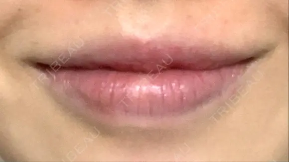 口唇縮小術 B-LINE CLINIC 池袋院 DAY 94 メイン用