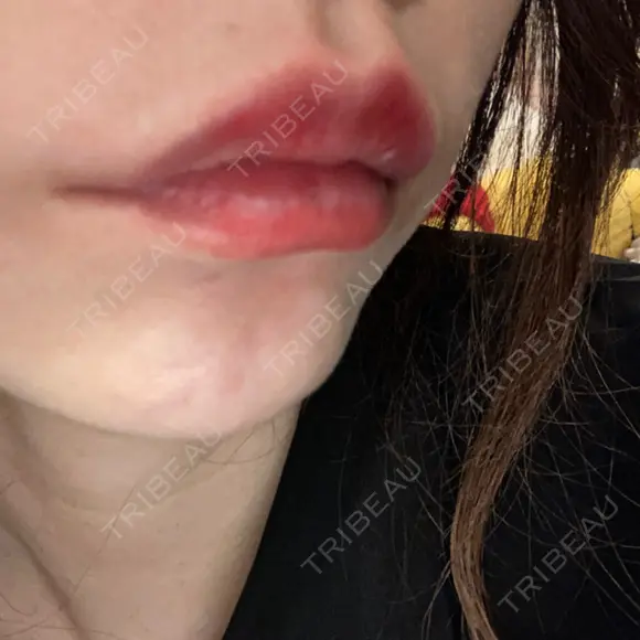 ヒアルロン酸注入（唇） / ボトックス（口角） ルラ美容クリニック 高田馬場院 DAY 9 メイン用