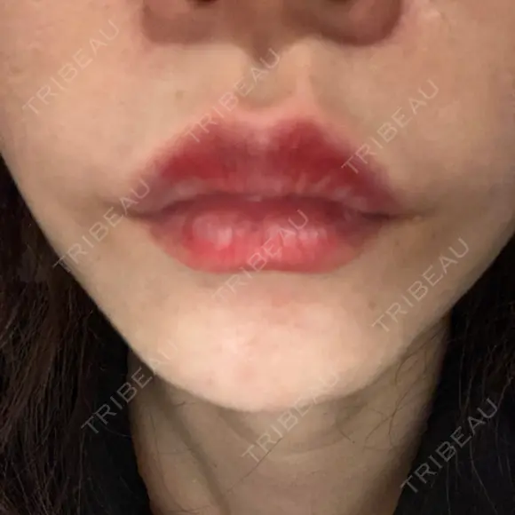 ヒアルロン酸注入（唇） / ボトックス（口角） ルラ美容クリニック 高田馬場院 DAY 9 メイン用