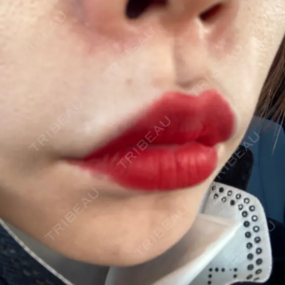 ヒアルロン酸注入（唇） / ボトックス（口角） ルラ美容クリニック 高田馬場院 DAY 10 メイン用