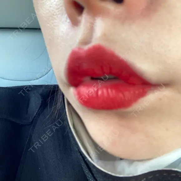 ヒアルロン酸注入（唇） / ボトックス（口角） ルラ美容クリニック 高田馬場院 DAY 10 メイン用