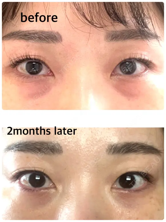 下まぶたの脂肪取り / 脂肪注入（目の下） セオリークリニック DAY 62 メイン用