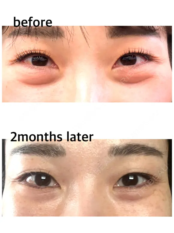 下まぶたの脂肪取り / 脂肪注入（目の下） セオリークリニック DAY 62 メイン用