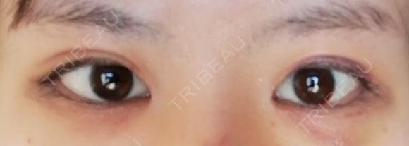 目頭切開 / 目尻切開 / 水光注射（ハリ・美肌） エートップ美容整形外科 DAY 11 メイン用