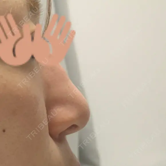 隆鼻術 アネシス美容クリニック AFTER メイン用