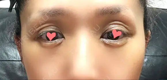 二重切開 / 眼瞼下垂（切開） / 上まぶたたるみ取り 心斎橋形成外科スキンケアクリニック DAY 63 メイン用