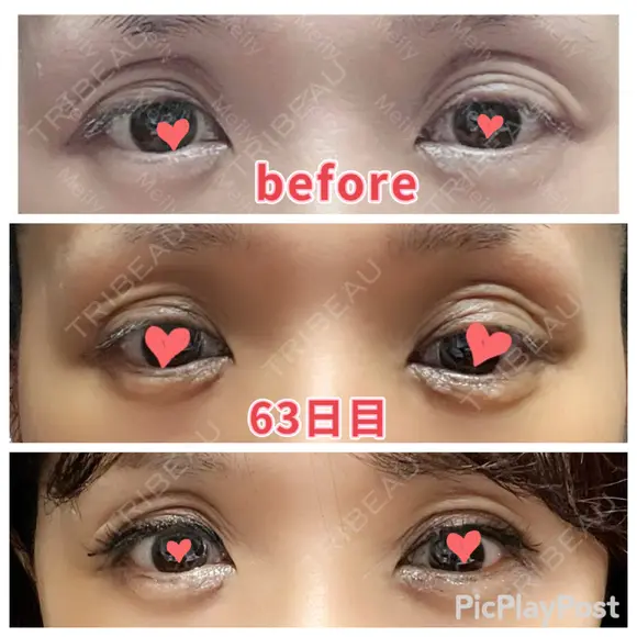 二重切開 / 眼瞼下垂（切開） / 上まぶたたるみ取り 心斎橋形成外科スキンケアクリニック DAY 63 メイン用