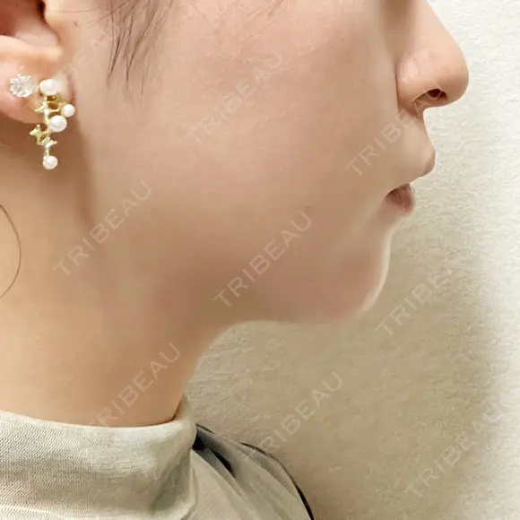 ボトックス（あご） / ヒアルロン酸注入（あご） ASTRA BEAUTY CLINIC AFTER メイン用