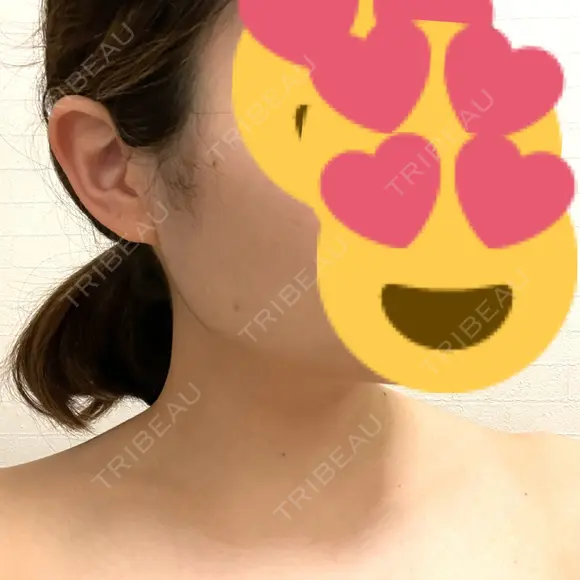 ボトックス（エラ・小顔） / ボトックス（肩） メディカルアルファクリニック DAY 5 メイン用