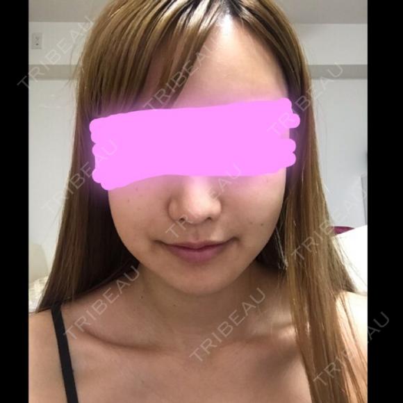 骨削り（エラ） / 骨削り（頬） / その他（輪郭） / 目尻切開 / タレ目形成・グラマラスライン（切開） / 輪郭修正 ウォンジン（Wonjin）整形外科 DAY 17 メイン用