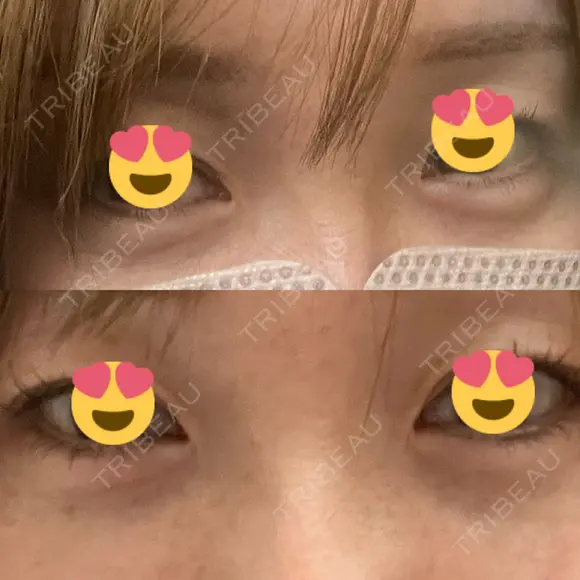 クマ治療 / 下まぶたの脂肪取り / ヒアルロン酸注入（目の下） / ボトックス（眉間） / ボトックス（目尻） / その他（鼻） YBC横浜美容外科 大宮院 DAY 7 メイン用