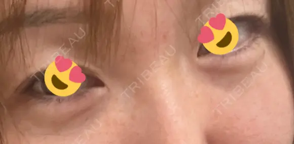 クマ治療 / 下まぶたの脂肪取り / ヒアルロン酸注入（目の下） / ボトックス（眉間） / ボトックス（目尻） / その他（鼻） YBC横浜美容外科 大宮院 AFTER メイン用