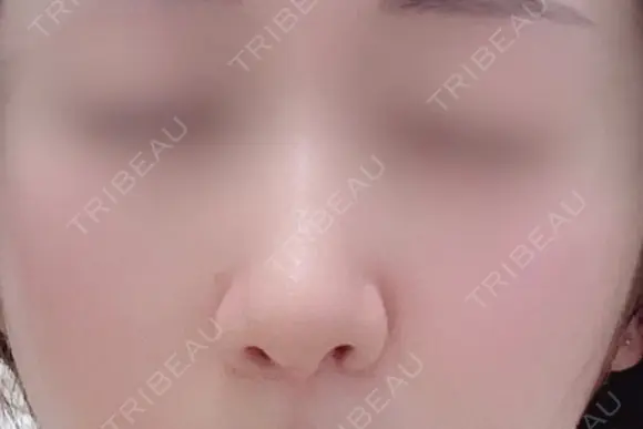 軟骨移植 ソウルクイーン整形外科（旧コエンミ整形外科） DAY 21 メイン用