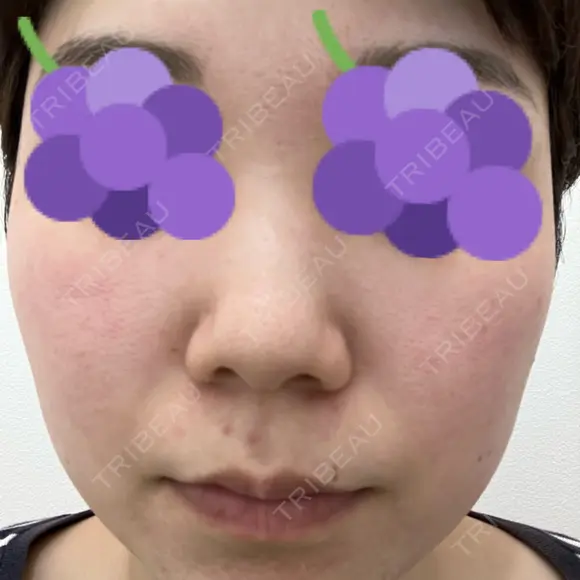 ピーリング（ハリ・ツヤ） まゆりなclinic 名古屋栄 DAY 0 メイン用