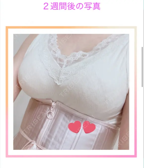 豊胸（脂肪注入） / その他（胸） クリニックビューティー恵比寿 DAY 646 メイン用