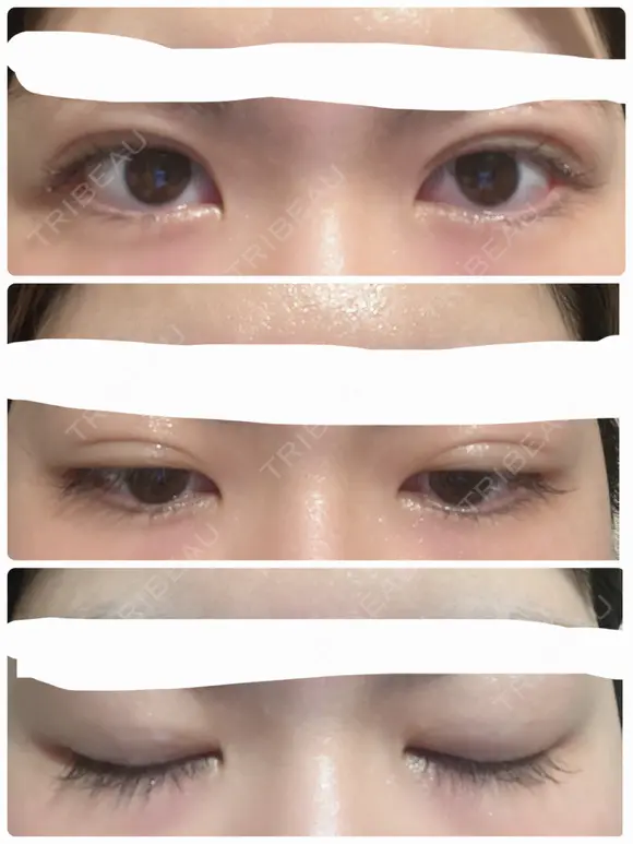 二重埋没 湘南美容クリニック 仙台院 DAY 27 メイン用