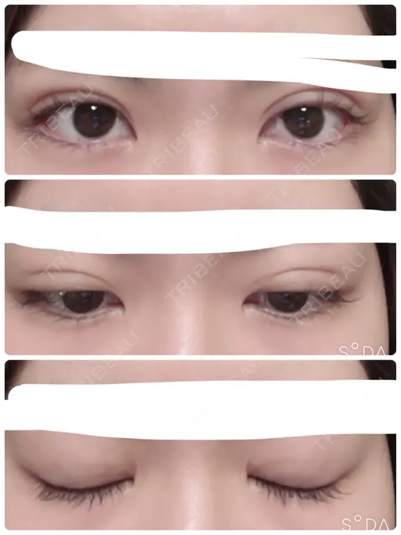 二重埋没 湘南美容クリニック 仙台院 DAY 9 メイン用