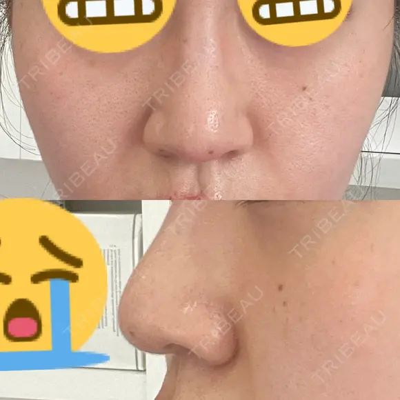 鼻尖形成（切開） / 鼻尖縮小 / その他（鼻） 聖心美容クリニック 札幌院 AFTER メイン用