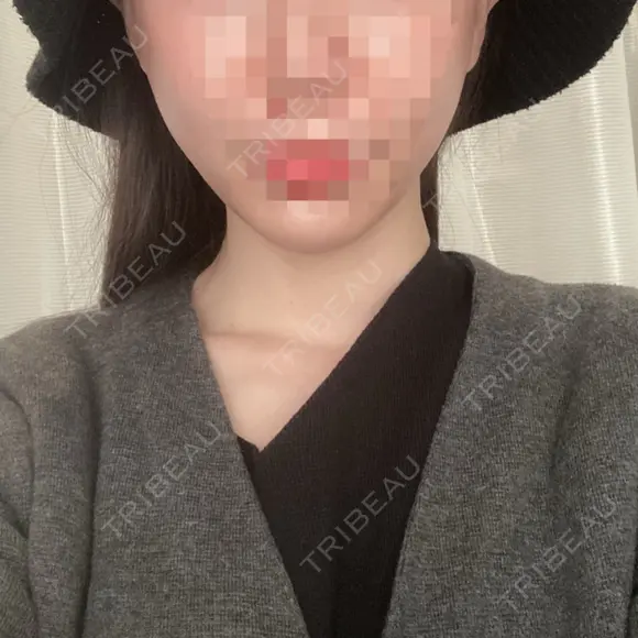 糸リフト / ルメッカ ブルームクリニック（BLOOM CLINIC） DAY 0 メイン用
