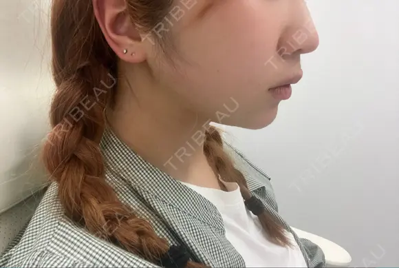 ヒアルロン酸注入（あご） / ボトックス（エラ・小顔） ASTRA BEAUTY CLINIC AFTER メイン用