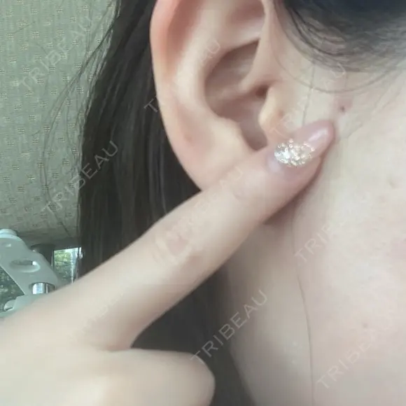 糸リフト / ルメッカ ブルームクリニック（BLOOM CLINIC） DAY 1 メイン用