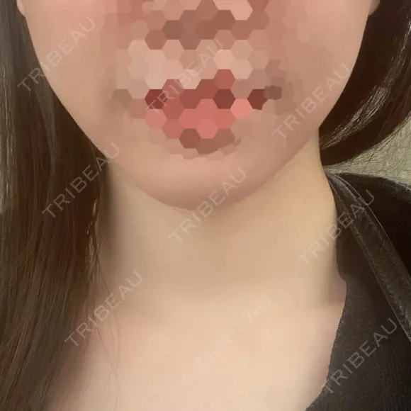 糸リフト / ルメッカ ブルームクリニック（BLOOM CLINIC） DAY 1 メイン用