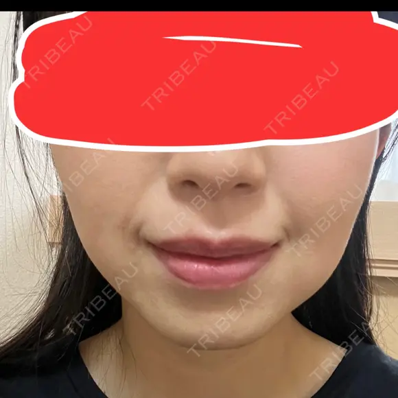 ボトックス（エラ・小顔） あいちビューティークリニック DAY 3 メイン用