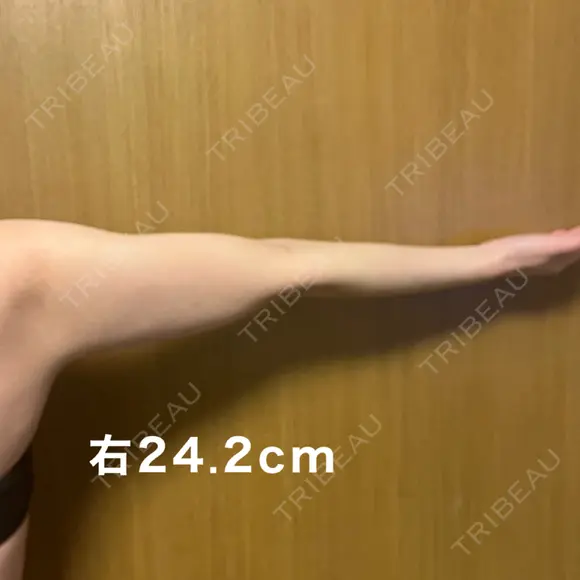 脂肪冷却（二の腕） みずほクリニック AFTER メイン用