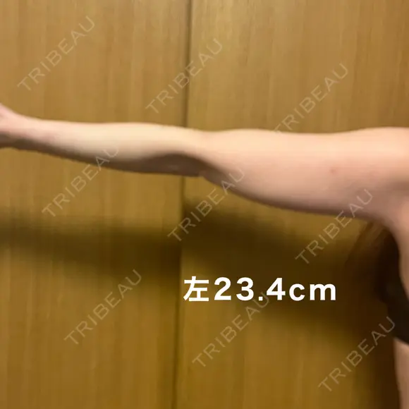 脂肪冷却（二の腕） みずほクリニック DAY 76 メイン用