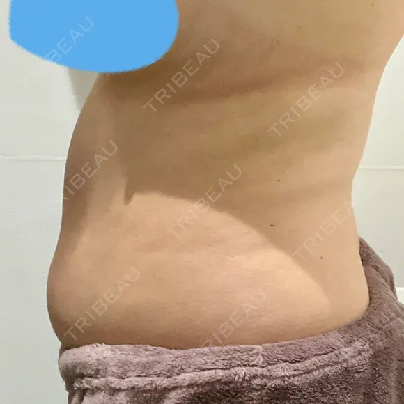脂肪冷却（お腹） 美容皮膚科エルムクリニック 大阪院 DAY 7 メイン用