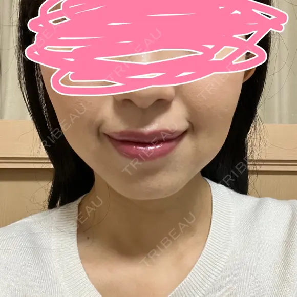 ボトックス（エラ・小顔） あいちビューティークリニック DAY 5 メイン用