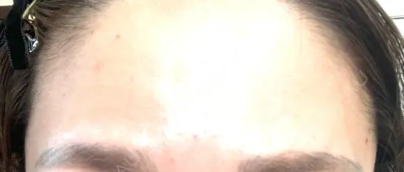 ボトックス（エラ・小顔） / ボトックス（眉間） / ボトックス（額） TCB東京中央美容外科 高崎院 DAY 0 メイン用