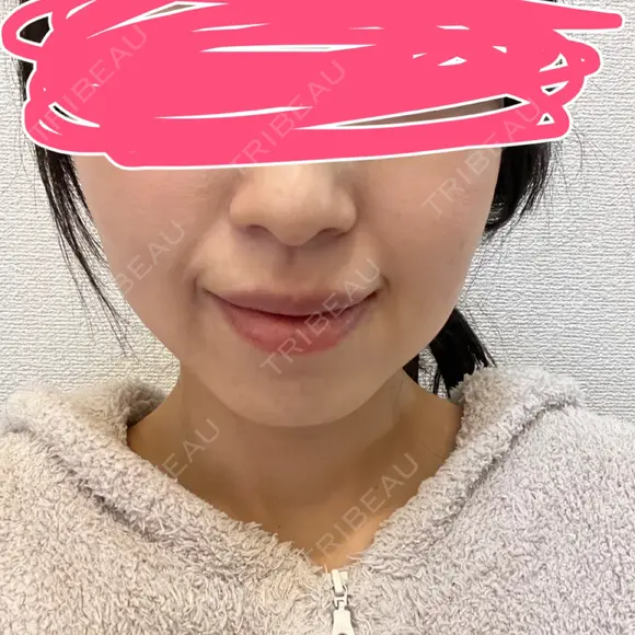 ボトックス（エラ・小顔） あいちビューティークリニック DAY 6 メイン用