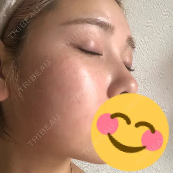 毛穴洗浄（ハイドラフェイシャルなど） / ピーリング（ハリ・ツヤ） / ミラノリピール Casa de GRACIA GINZA 【カーサデグラシアギンザ】 DAY 1 メイン用