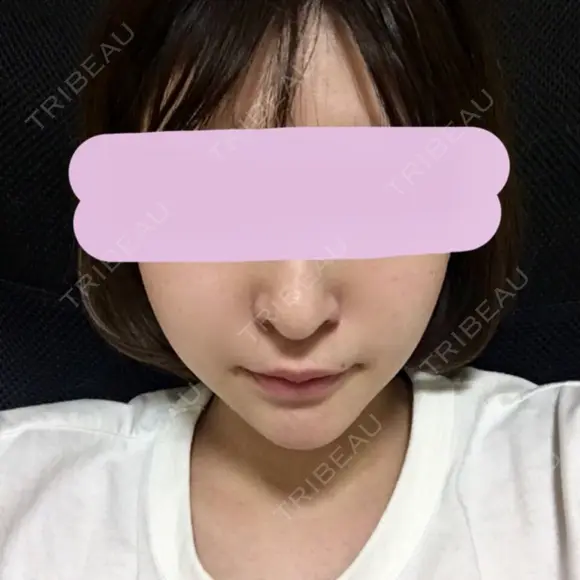 あごプロテーゼ 恵聖会クリニック 京橋院 DAY 39 メイン用