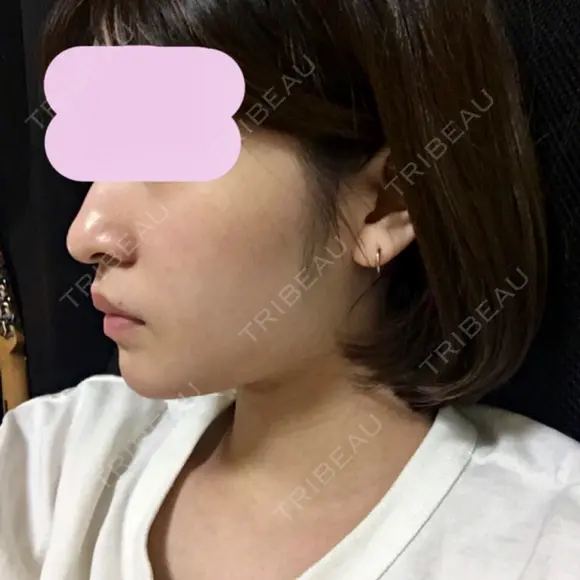 あごプロテーゼ 恵聖会クリニック 京橋院 DAY 39 メイン用