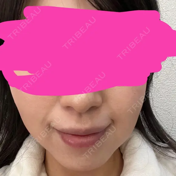 ボトックス（エラ・小顔） あいちビューティークリニック DAY 7 メイン用